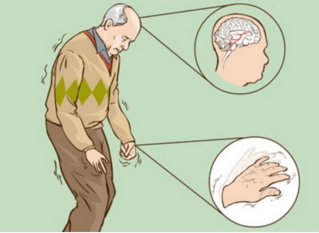 Bệnh Parkinson là gì? Nguyên nhân và cách điều trị