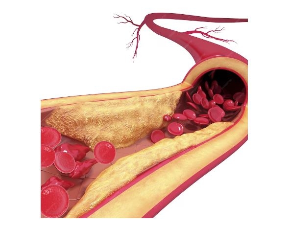 Cholesterol cao bao nhiêu là nguy hiểm?