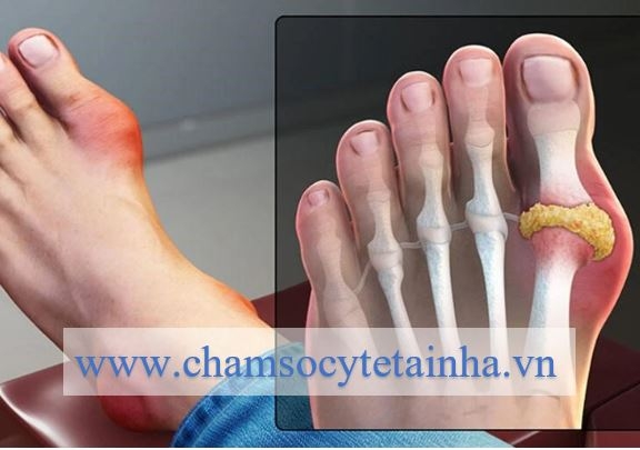 Gout Là Gì? Triệu Chứng Và Phương Pháp Xác Định