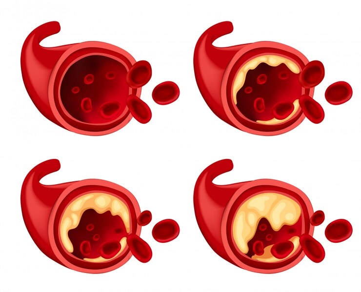 Kiểm soát thừa cholesterol: giảm 27% nguy cơ đột quỵ