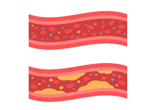 Những bệnh liên quan đến cholesterol cao