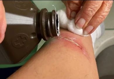 Những Loại Vết Thương Ngoài Da Không Nên Dùng Hydrogen Peroxide Để Rửa