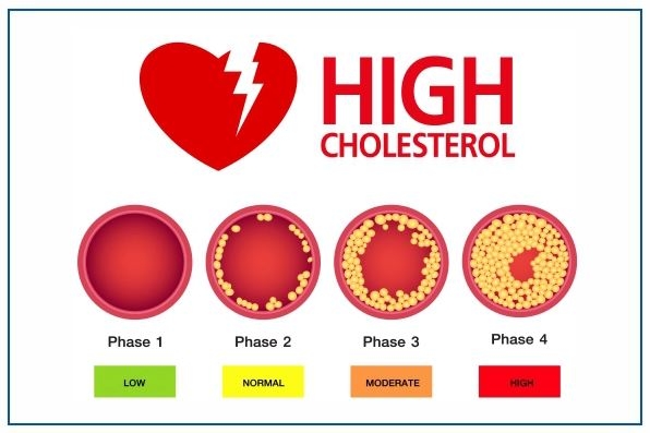 Tác Hại Của Mỡ Máu Cao Và Các Biện Pháp Hạn Chế Tăng Mỡ Máu