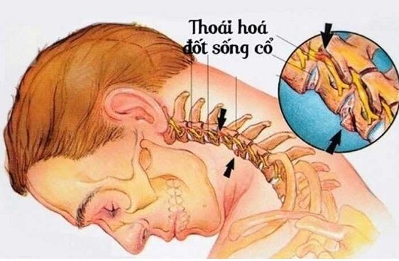 Thoái Hóa Đốt Sống Cổ: Lựa Chọn Thực Phẩm Chức Năng Hỗ Trợ Hiệu Quả