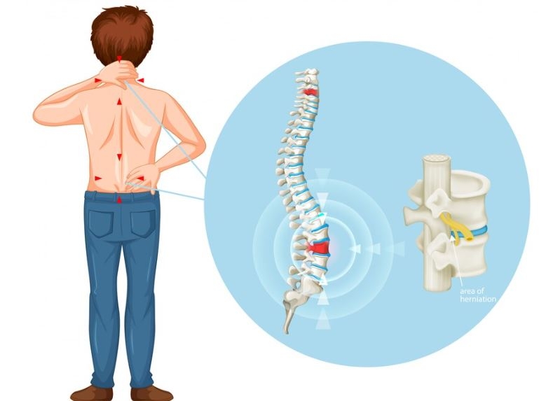 Thoát Vị Đĩa Đệm Cột Sống Thắt Lưng: Nguyên Nhân, Triệu Chứng và Cách Điều Trị