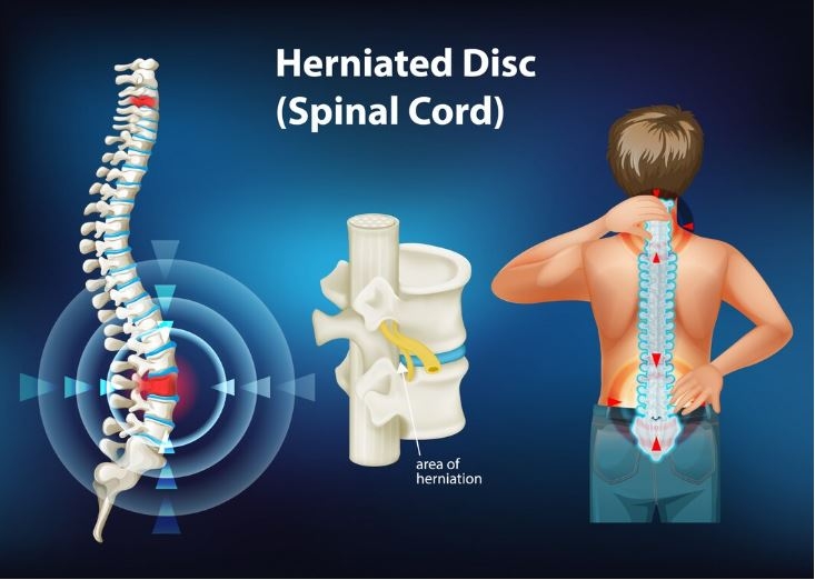Thoát Vị Đĩa Đệm: Nguyên Nhân, Triệu Chứng và Cách Điều Trị
