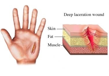 Thời Gian Vết Thương Lên Da Non: Các Yếu Tố Ảnh Hưởng và Quá Trình Lành