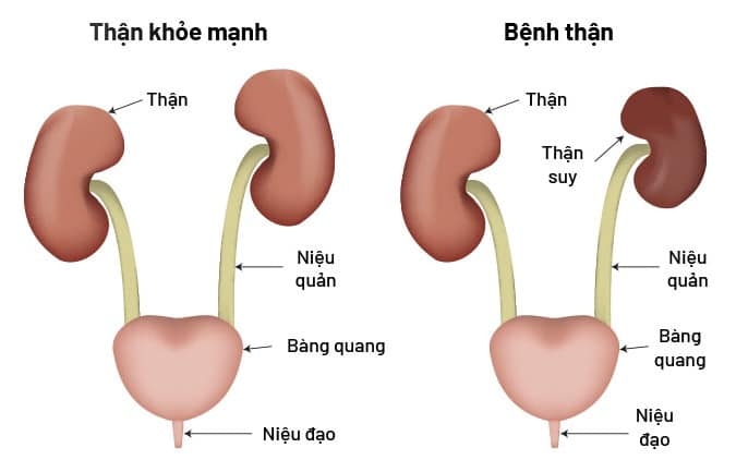 TỔNG QUAN VỀ SUY THẬN MÃN