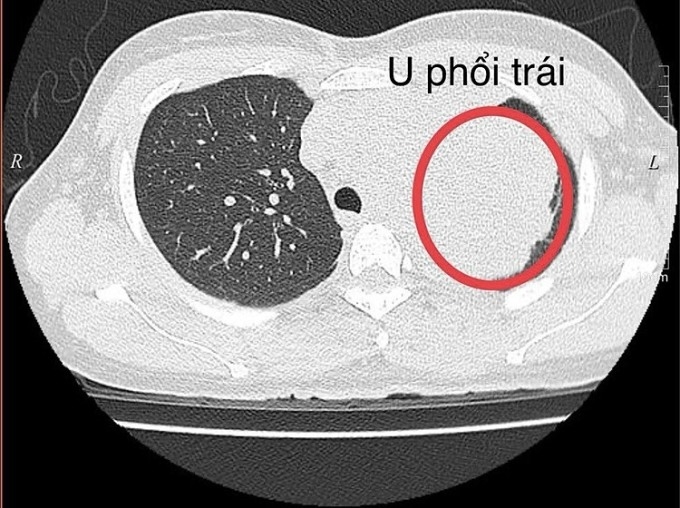 Ung thư phổi ở tuổi 34