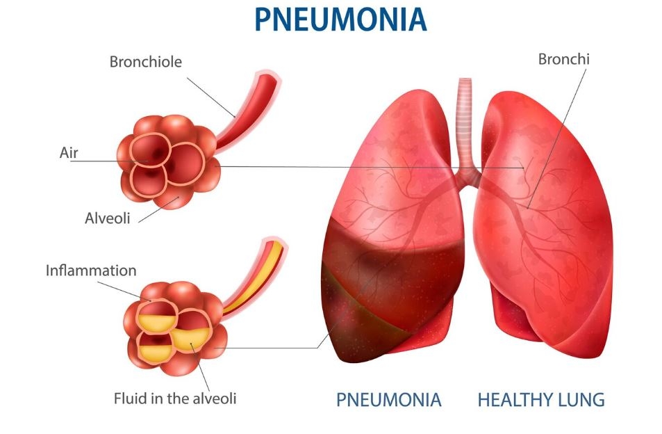 Viêm phổi là gì? Triệu chứng, Phương pháp điều trị và cách phòng ngừa