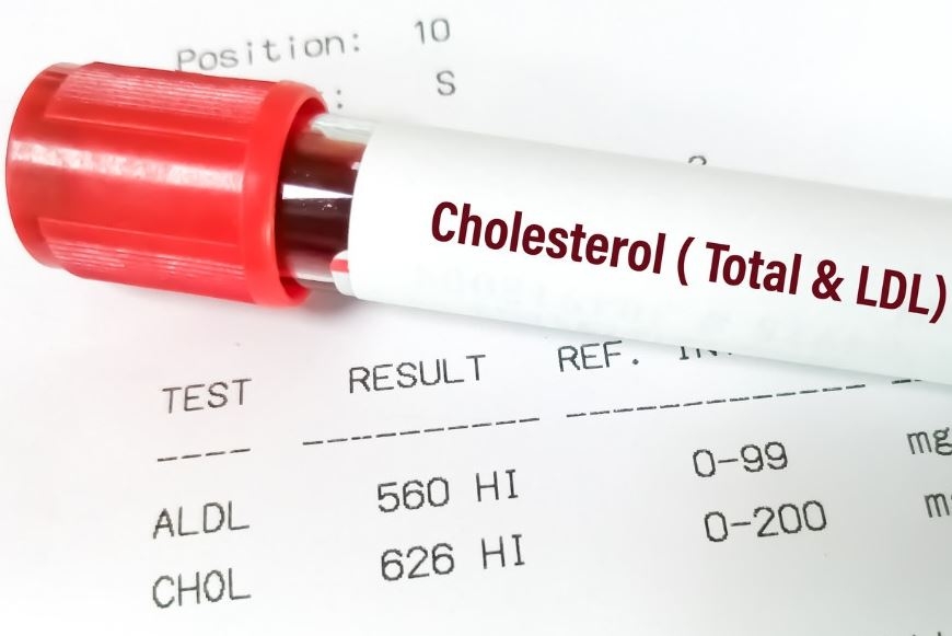 Xét Nghiệm Cholesterol LDL: Ý Nghĩa và Tầm Quan Trọng Trong Đánh Giá Sức Khỏe Tim Mạch