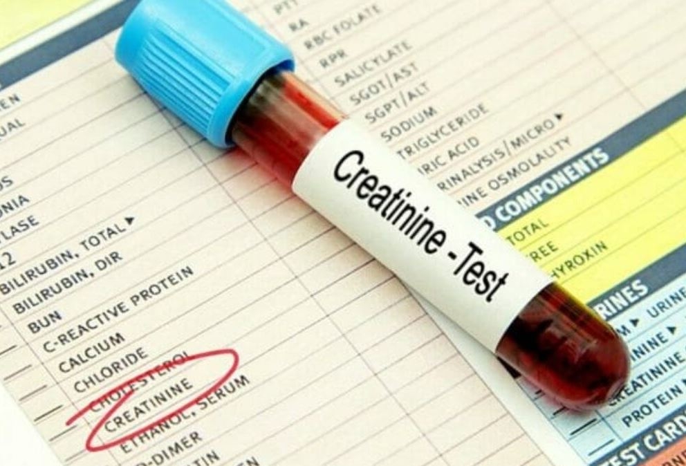 Xét Nghiệm Creatinine Máu: Ý Nghĩa và Ứng Dụng Trong Đánh Giá Chức Năng Thận